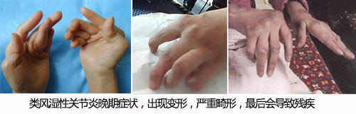 类风湿关节炎.png