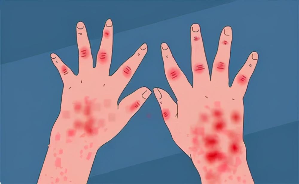 银屑病.jpg