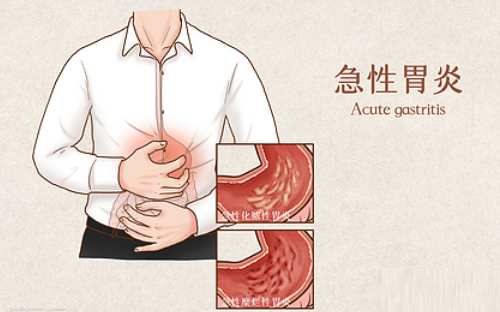 急性胃炎.png