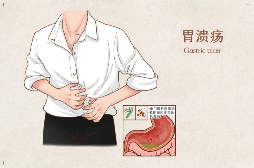 胃溃疡01.jpg