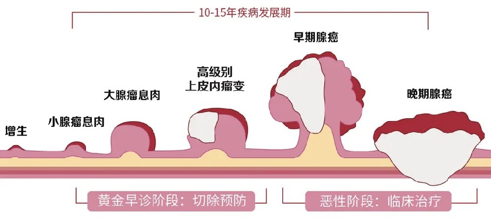 肠癌变化10年.jpg