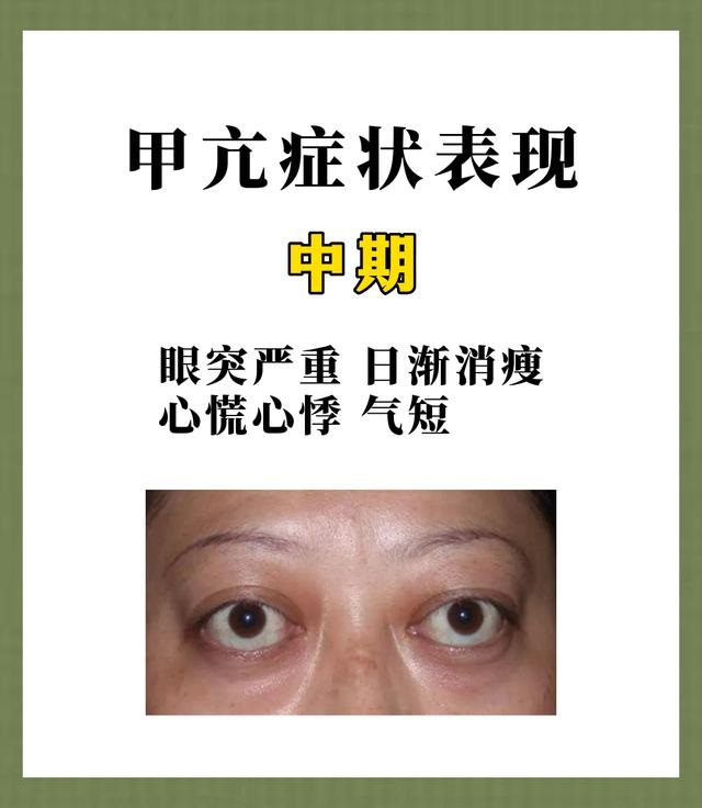 甲亢中期症状01.jpg