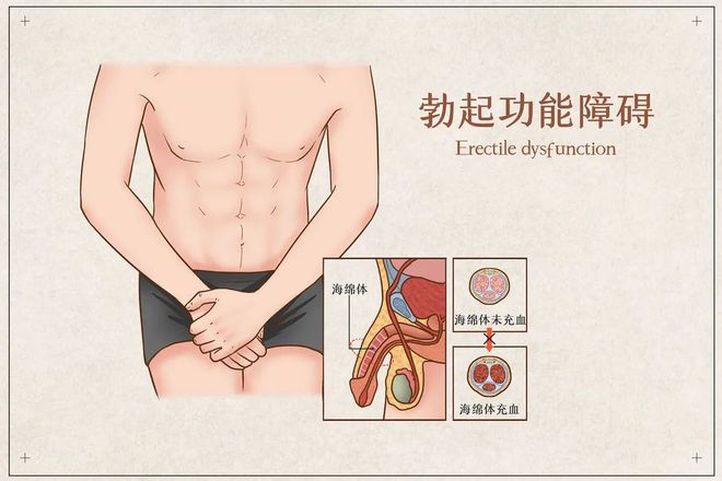 早泄勃起困难.jpg